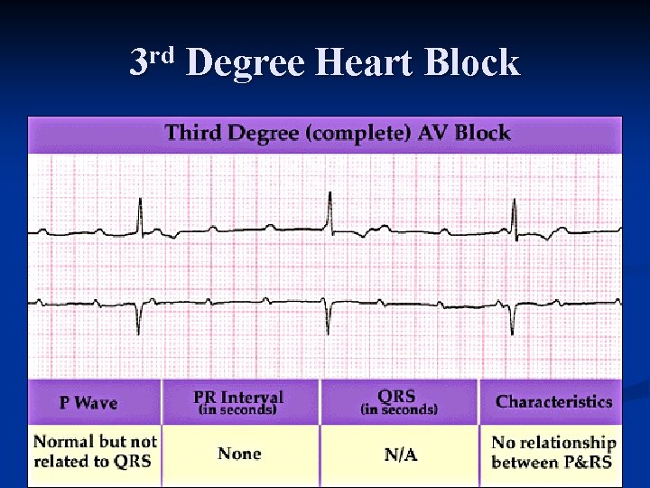 3 rd Degree Heart Block 