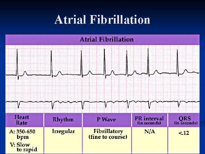 Atrial Fibrillation 