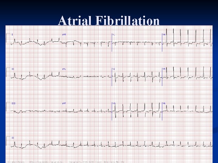 Atrial Fibrillation 