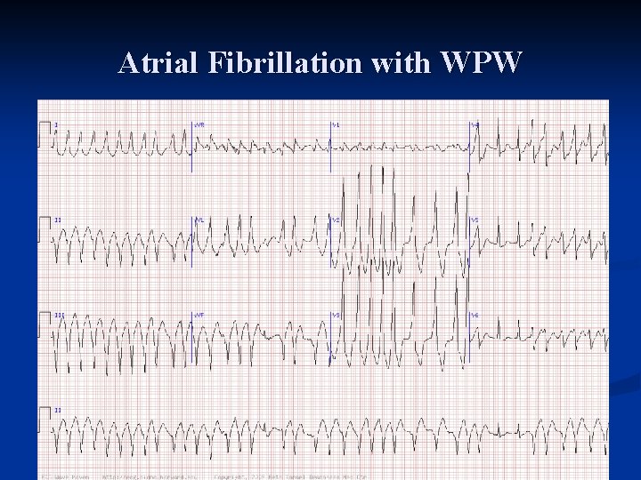 Atrial Fibrillation with WPW 