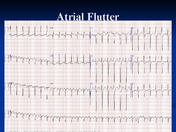 Atrial Flutter 