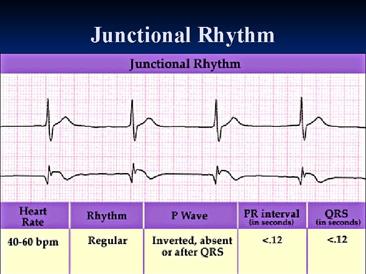 Junctional Rhythm 