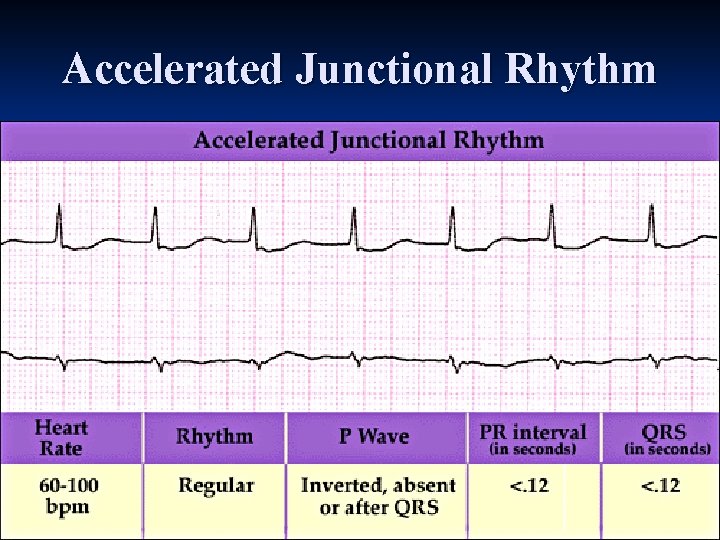 Accelerated Junctional Rhythm 