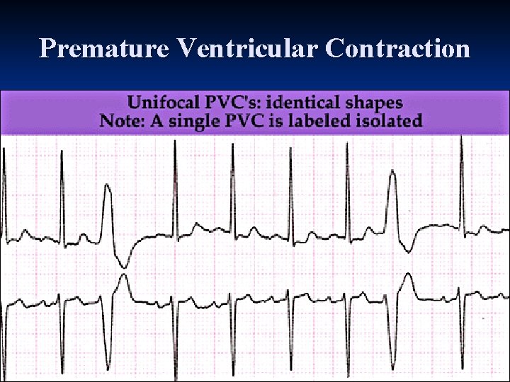 Premature Ventricular Contraction 