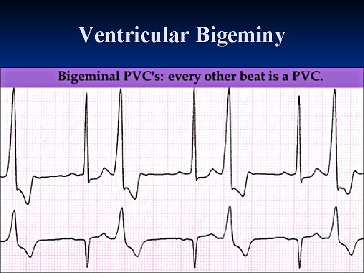 Ventricular Bigeminy 