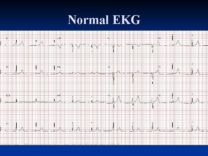 Normal EKG 