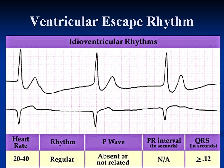 Ventricular Escape Rhythm 