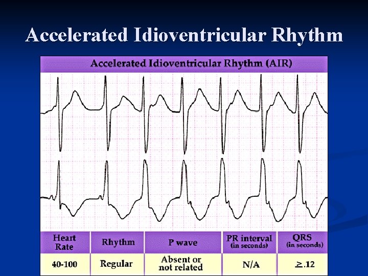 Accelerated Idioventricular Rhythm 