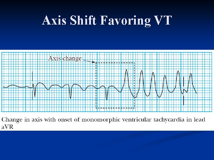 Axis Shift Favoring VT 