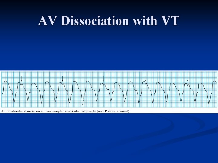 AV Dissociation with VT 