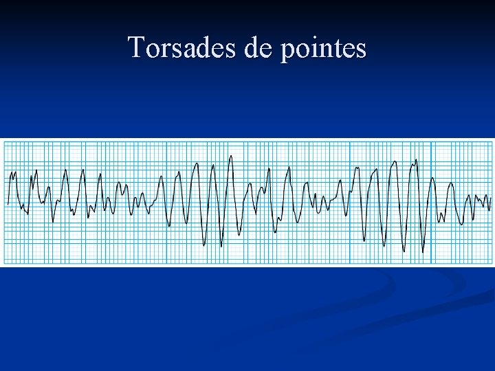 Torsades de pointes 