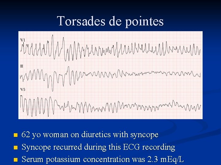 Torsades de pointes n n n 62 yo woman on diuretics with syncope Syncope