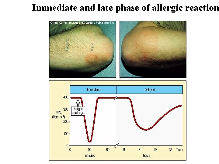 Immediate and late phase of allergic reaction Immediate and late phase of allergic reaction