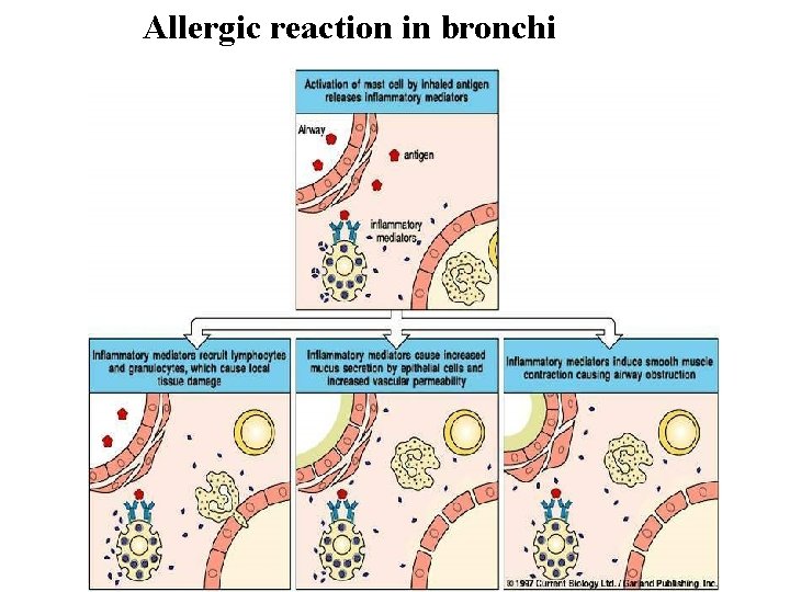 Allergic reaction in bronchi Allergic reaction in bronchi