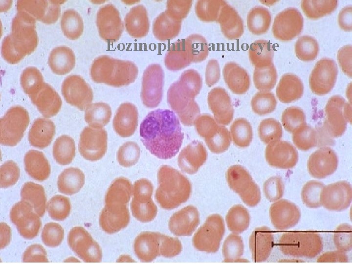 Eozinophil granulocyte Eozinophil granulocyte