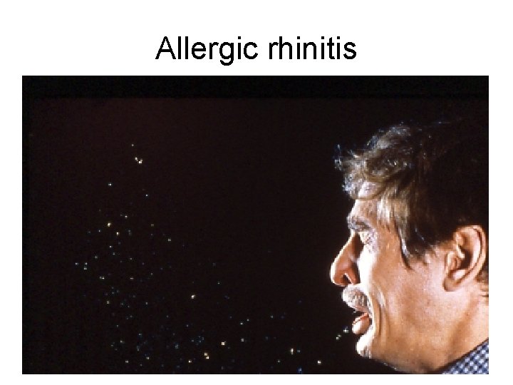 Allergic rhinitis Allergic rhinitis