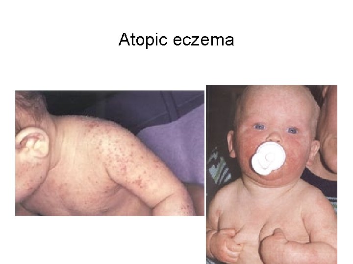 Atopic eczema Atopic eczema