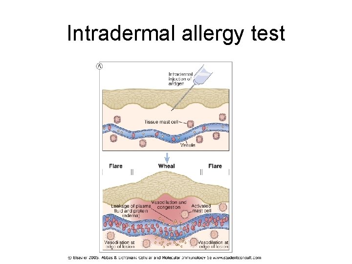 Intradermal allergy test Intradermal allergy test