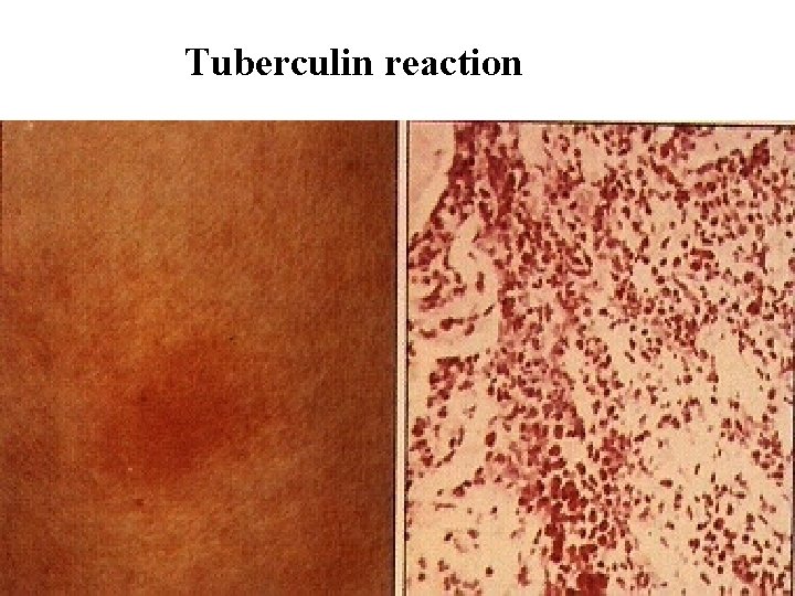 Tuberculin reaction Tuberculin reaction