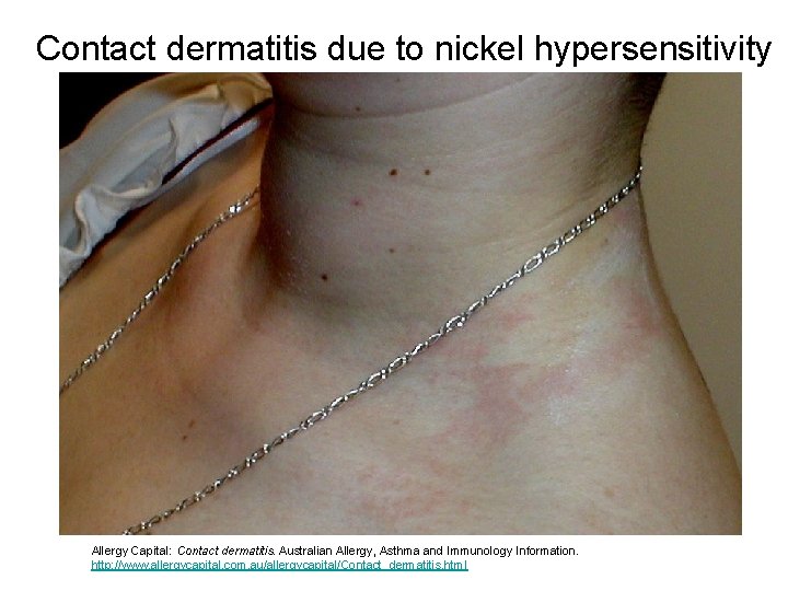 Contact dermatitis due to nickel hypersensitivity Allergy Capital: Contact dermatitis. Australian Allergy, Asthma and Contact dermatitis due to nickel hypersensitivity Allergy Capital: Contact dermatitis. Australian Allergy, Asthma and