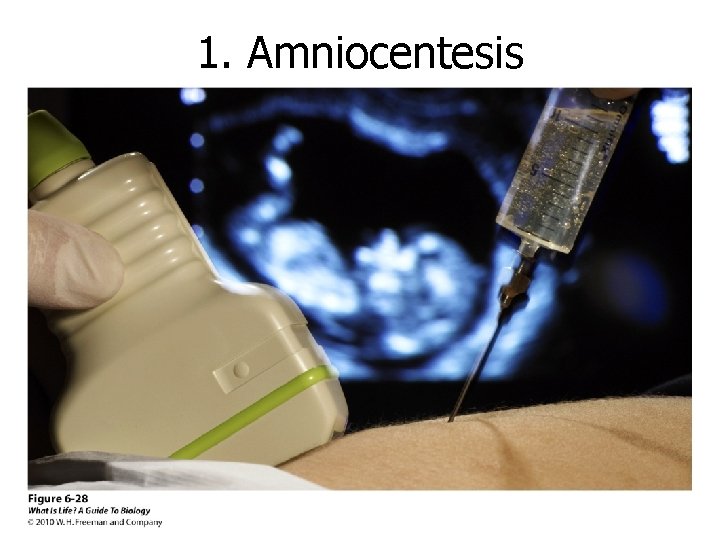 1. Amniocentesis 1. Amniocentesis