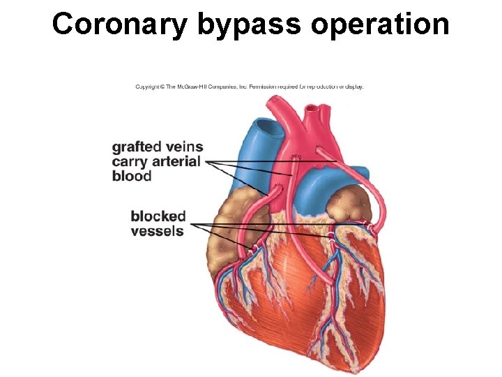 Coronary bypass operation 