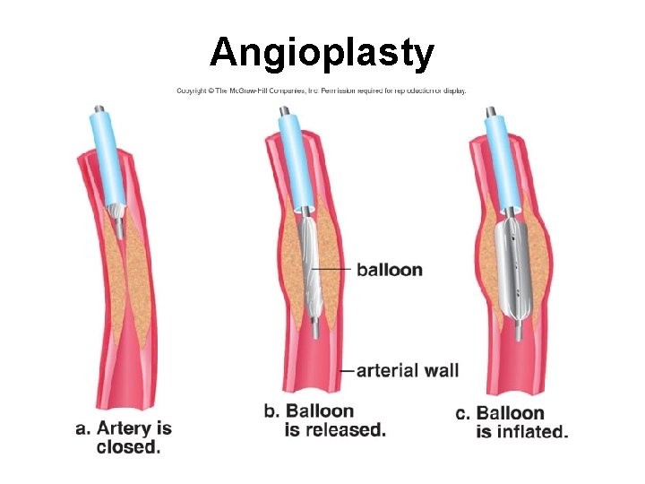 Angioplasty 