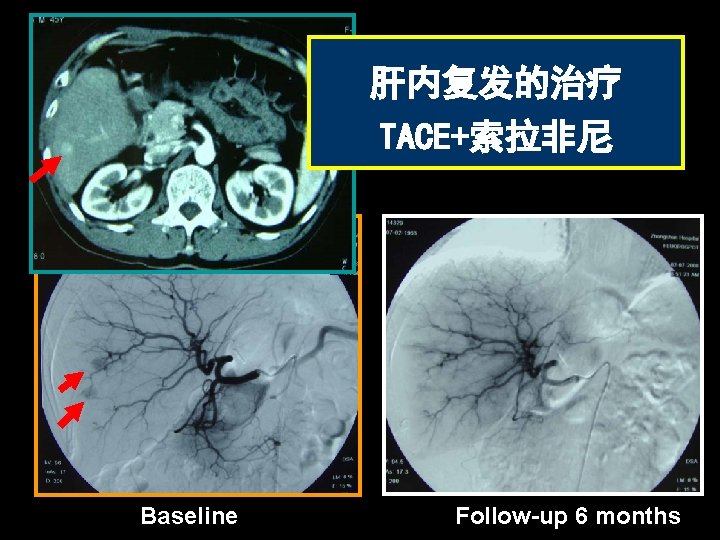 肝内复发的治疗 TACE+索拉非尼 Baseline Follow-up 6 months 