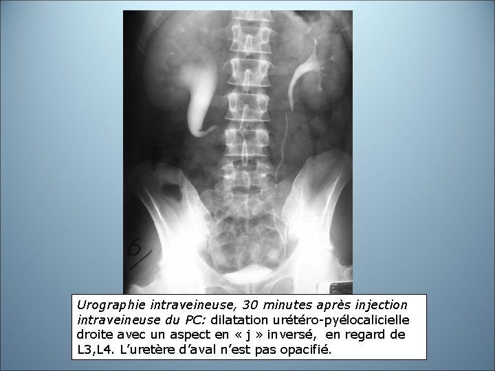 Urographie intraveineuse, 30 minutes après injection intraveineuse du PC: dilatation urétéro-pyélocalicielle droite avec un