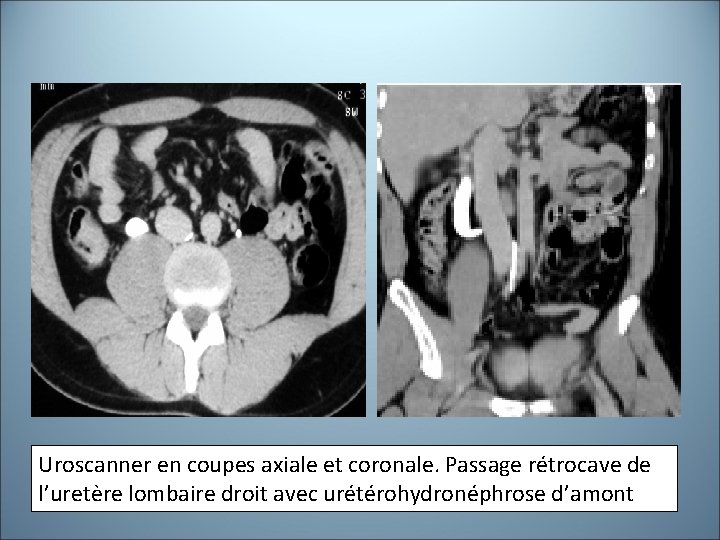 Uroscanner en coupes axiale et coronale. Passage rétrocave de l’uretère lombaire droit avec urétérohydronéphrose