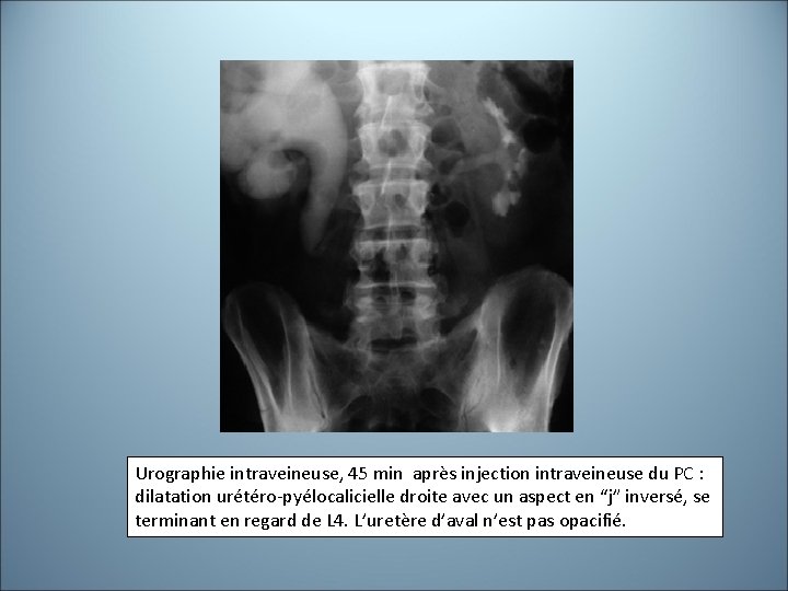 Urographie intraveineuse, 45 min après injection intraveineuse du PC : dilatation urétéro-pyélocalicielle droite avec