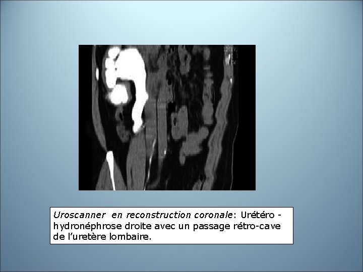 Uroscanner en reconstruction coronale: Urétéro - hydronéphrose droite avec un passage rétro-cave de l’uretère Uroscanner en reconstruction coronale: Urétéro - hydronéphrose droite avec un passage rétro-cave de l’uretère