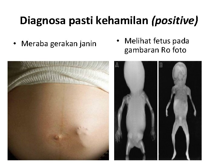 Diagnosa pasti kehamilan (positive) • Meraba gerakan janin • Melihat fetus pada gambaran Ro