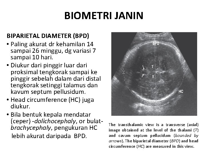 BIOMETRI JANIN BIPARIETAL DIAMETER (BPD) • Paling akurat dr kehamilan 14 sampai 26 minggu,