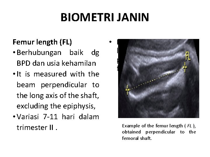 BIOMETRI JANIN Femur length (FL) • Berhubungan baik dg BPD dan usia kehamilan •