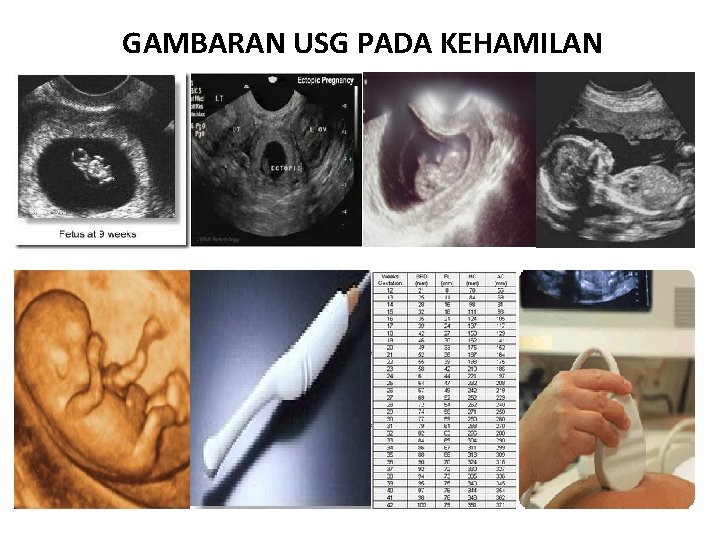 GAMBARAN USG PADA KEHAMILAN 