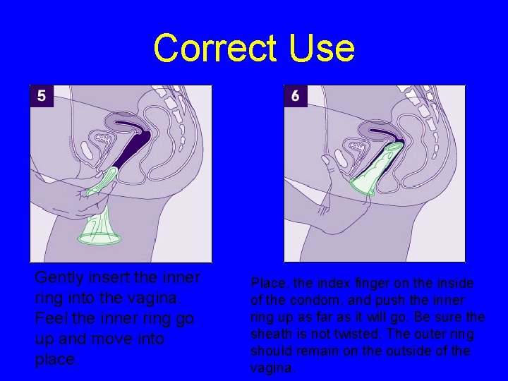 Correct Use Gently insert the inner ring into the vagina. Feel the inner ring