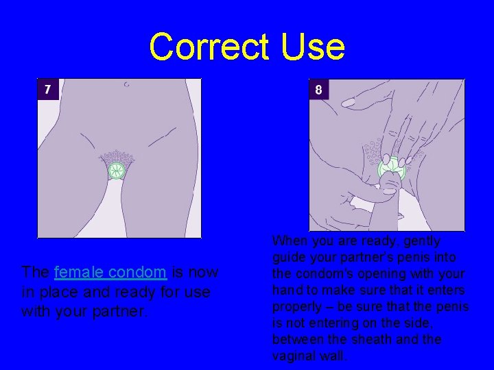 Correct Use The female condom is now in place and ready for use with