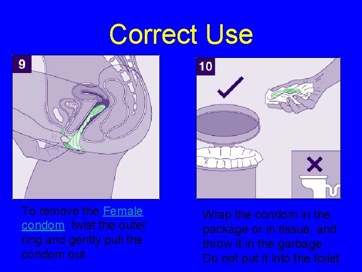 Correct Use To remove the Female condom, twist the outer ring and gently pull