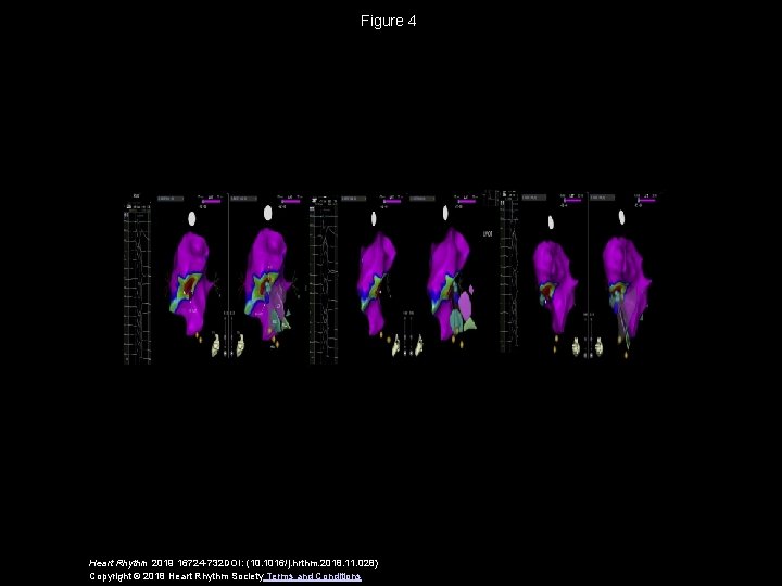 Figure 4 Heart Rhythm 2019 16724 -732 DOI: (10. 1016/j. hrthm. 2018. 11. 028)