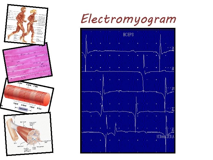 Electromyogram 