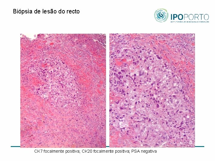 Biópsia de lesão do recto CK 7 focalmente positiva; CK 20 focalmente positiva; PSA