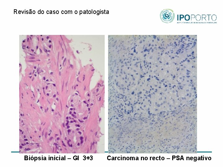 Revisão do caso com o patologista Biópsia inicial – Gl 3+3 Carcinoma no recto