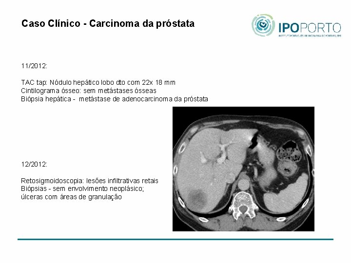 Caso Clínico - Carcinoma da próstata 11/2012: TAC tap: Nódulo hepático lobo dto com