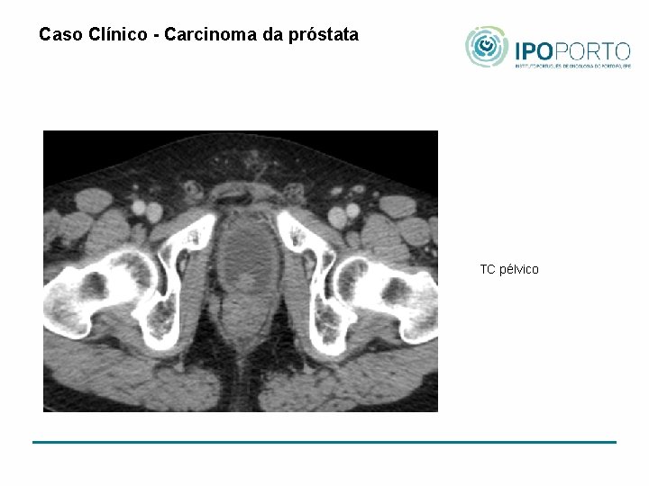 Caso Clínico - Carcinoma da próstata TC pélvico 