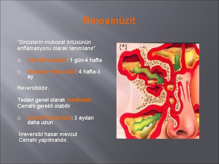 Rinosinüzit “Sinüslerin mukozal örtüsünün enflamasyonu olarak tanımlanır” Akut Rinosinüzit: 1 gün-4 hafta Subakut Rinosinüzit: