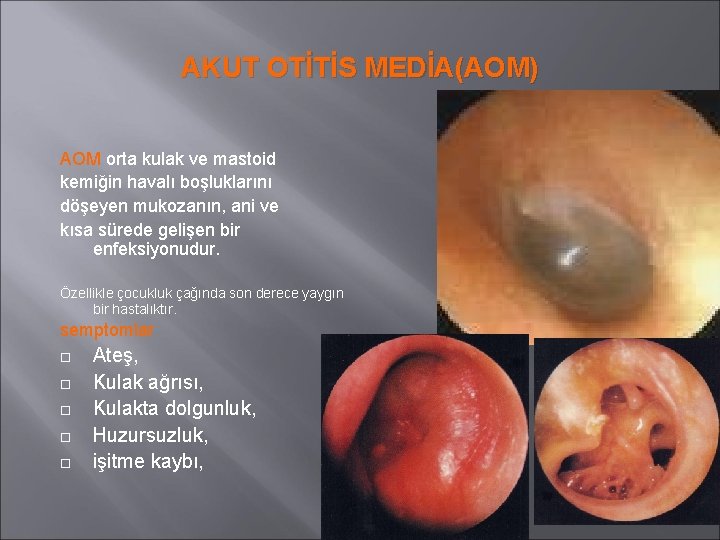 AKUT OTİTİS MEDİA(AOM) AOM orta kulak ve mastoid kemiğin havalı boşluklarını döşeyen mukozanın, ani