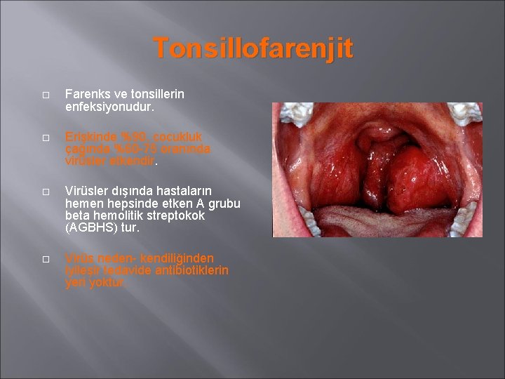 Tonsillofarenjit Farenks ve tonsillerin enfeksiyonudur. Erişkinde %90, cocukluk çağında %60 -75 oranında virüsler etkendir.