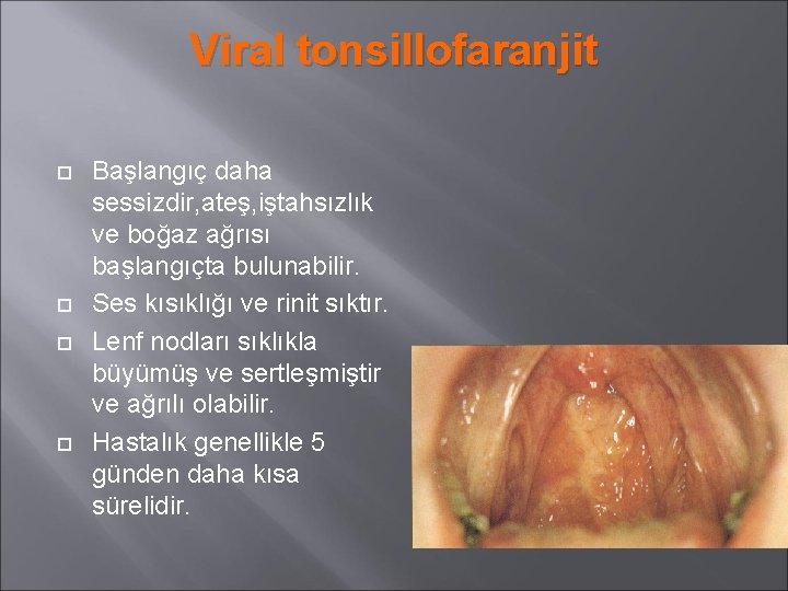 Viral tonsillofaranjit Başlangıç daha sessizdir, ateş, iştahsızlık ve boğaz ağrısı başlangıçta bulunabilir. Ses kısıklığı