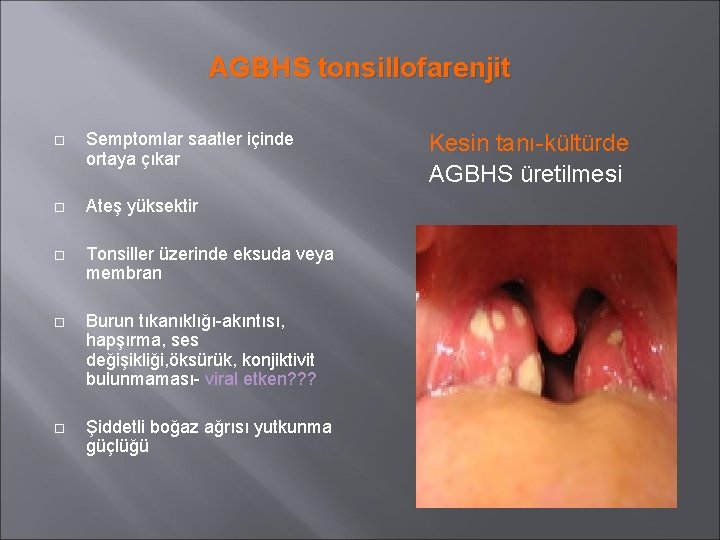 AGBHS tonsillofarenjit Semptomlar saatler içinde ortaya çıkar Ateş yüksektir Tonsiller üzerinde eksuda veya membran